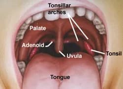 Tonsil Stones Remedy